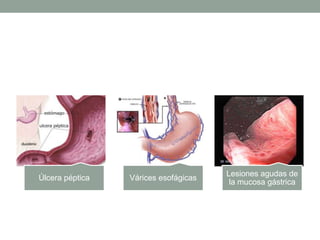 Úlcera péptica Várices esofágicas
Lesiones agudas de
la mucosa gástrica
 