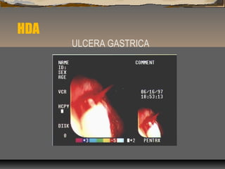 HDA
ULCERA GASTRICA
 