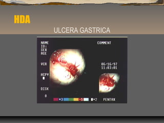 HDA
ULCERA GASTRICA
 