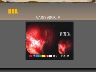 HDA
VASO VISIBLE
 