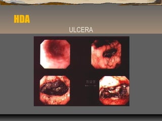 HDA
ULCERA
 