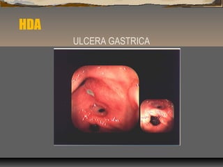 HDA
ULCERA GASTRICA
 