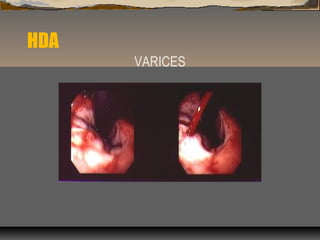 HDA
VARICES
 