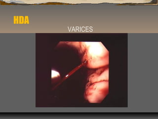 HDA
VARICES
 
