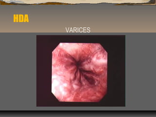 HDA
VARICES
 
