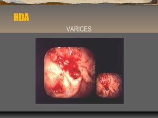 HDA
VARICES
 