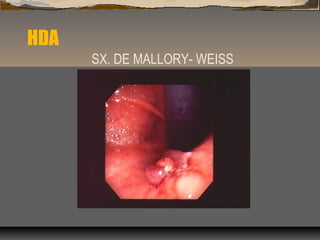 HDA
SX. DE MALLORY- WEISS
 