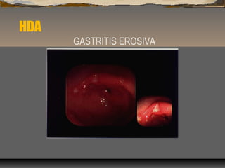 HDA
GASTRITIS EROSIVA
 