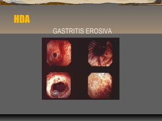HDA
GASTRITIS EROSIVA
 