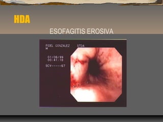 HDA
ESOFAGITIS EROSIVA
 