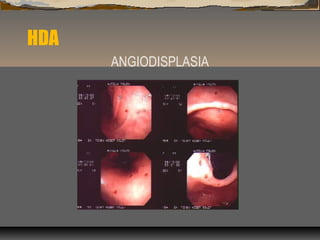 HDA
ANGIODISPLASIA
 