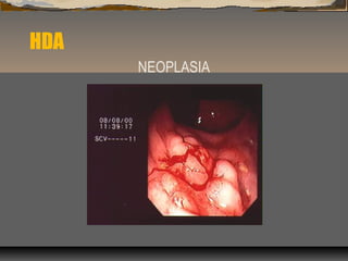 HDA
NEOPLASIA
 