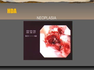 HDA
NEOPLASIA
 