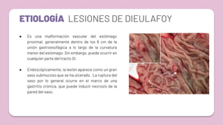 ETIOLOGÍA LESIONES DE DIEULAFOY
● Es una malformación vascular del estómago
proximal, generalmente dentro de los 6 cm de la
unión gastroesofágica a lo largo de la curvatura
menor del estómago. Sin embargo, puede ocurrir en
cualquier parte del tracto GI.
● Endoscópicamente, la lesión aparece como un gran
vaso submucoso que se ha ulcerado. La ruptura del
vaso por lo general ocurre en el marco de una
gastritis crónica, que puede inducir necrosis de la
pared del vaso.
 