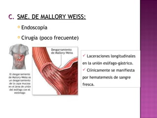 C.C. SME. DE MALLORY WEISS:SME. DE MALLORY WEISS:
 Endoscopía
 Cirugía (poco frecuente)
 Laceraciones longitudinales
en la unión esófago-gástrico.
 Clínicamente se manifiesta
por hematemesis de sangre
fresca.
 