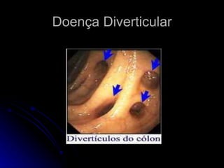 Doença Diverticular 