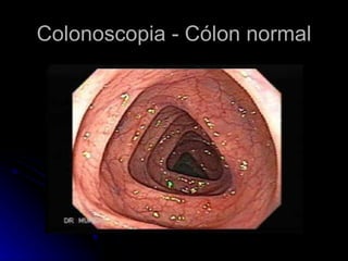 Colonoscopia - Cólon normal 