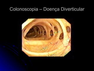 Colonoscopia – Doença Diverticular 