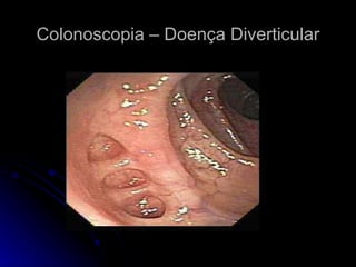 Colonoscopia – Doença Diverticular 