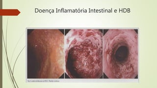 Doença Inflamatória Intestinal e HDB
 