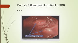 Doença Inflamatória Intestinal e HDB
 RCU
 