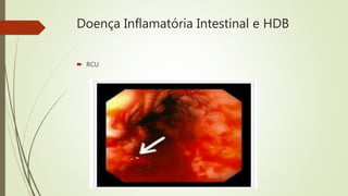 Doença Inflamatória Intestinal e HDB
 RCU
 