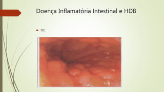 Doença Inflamatória Intestinal e HDB
 DC:
 