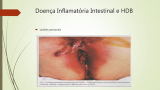 Doença Inflamatória Intestinal e HDB
 Lesões perianais
 