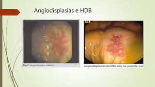 Angiodisplasias e HDB
 