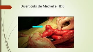 Divertículo de Meckel e HDB
 