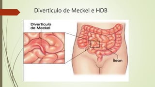 Divertículo de Meckel e HDB
 