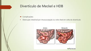 Divertículo de Meckel e HDB
 Complicações:
 Obstrução intestinal por intussuscepção ou volvo ileal em volta do divertículo
 