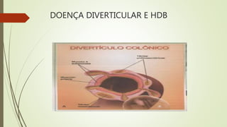 DOENÇA DIVERTICULAR E HDB
 