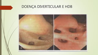 DOENÇA DIVERTICULAR E HDB
 