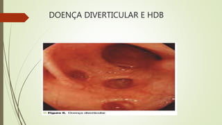 DOENÇA DIVERTICULAR E HDB
 