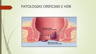 PATOLOGIAS ORIFICIAIS E HDB
 
