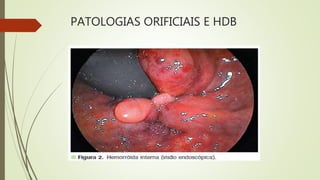 PATOLOGIAS ORIFICIAIS E HDB
 