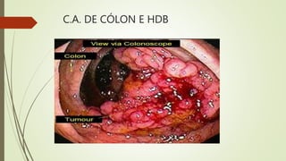 C.A. DE CÓLON E HDB
 