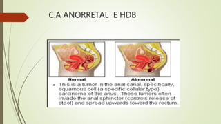 C.A ANORRETAL E HDB
 