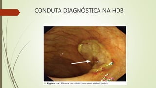 CONDUTA DIAGNÓSTICA NA HDB
 