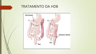 TRATAMENTO DA HDB
 
