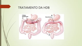 TRATAMENTO DA HDB
 