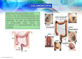 INTUSUSCEPCIÓN INTESTINALANGIODISPLASIA O ECTASIAS VASCULARESFIEBRE TIFOIDEAOTRAS CAUSAS