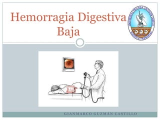 Hemorragia Digestiva
       Baja




         GIANMARCO GUZMÁN CASTILLO
 