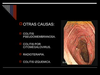  OTRAS CAUSAS:
 COLITIS

PSEUDOMEMBRANOSA.

 COLITIS POR

CITOMEGALOVIRUS.

 RADIOTERAPIA.
 COLITIS IZQUEMICA.

 