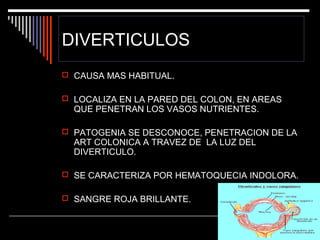 DIVERTICULOS
 CAUSA MAS HABITUAL.
 LOCALIZA EN LA PARED DEL COLON, EN AREAS

QUE PENETRAN LOS VASOS NUTRIENTES.

 PATOGENIA SE DESCONOCE, PENETRACION DE LA

ART COLONICA A TRAVEZ DE LA LUZ DEL
DIVERTICULO.

 SE CARACTERIZA POR HEMATOQUECIA INDOLORA.
 SANGRE ROJA BRILLANTE.

 