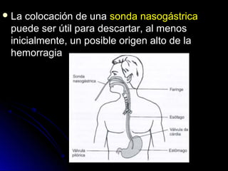 La colocación de unaLa colocación de una sonda nasogástricasonda nasogástrica
puede ser útil para descartar, al menospuede ser útil para descartar, al menos
inicialmente, un posible origen alto de lainicialmente, un posible origen alto de la
hemorragiahemorragia
 