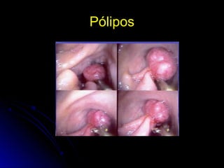 PóliposPólipos
 