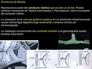 Divertículo de Meckel.
Representa la parte delRepresenta la parte del conductoconducto vitelinovitelino que seque se abre en el íleoabre en el íleo. Puede. Puede
contener remanente de Tejidos estomacales o Pancreáticos. cierre incompletocontener remanente de Tejidos estomacales o Pancreáticos. cierre incompleto
del conducto vitelino.del conducto vitelino.
La ulceración de laLa ulceración de la mucosa gástrica ectópicamucosa gástrica ectópica en un divertículo intestinal puedeen un divertículo intestinal puede
causar hemorragia digestiva baja recidivante o anemia crónica porcausar hemorragia digestiva baja recidivante o anemia crónica por
microsangrado.microsangrado.
La radiología convencional conLa radiología convencional con contraste baritadocontraste baritado o la gammagrafía sueleno la gammagrafía suelen
localizar esta lesión.localizar esta lesión.
 