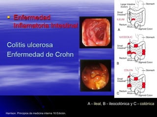 A - ileal, B - ileocolónica y C - colónica
Harrison. Principios de medicina interna 16 Edición.
 